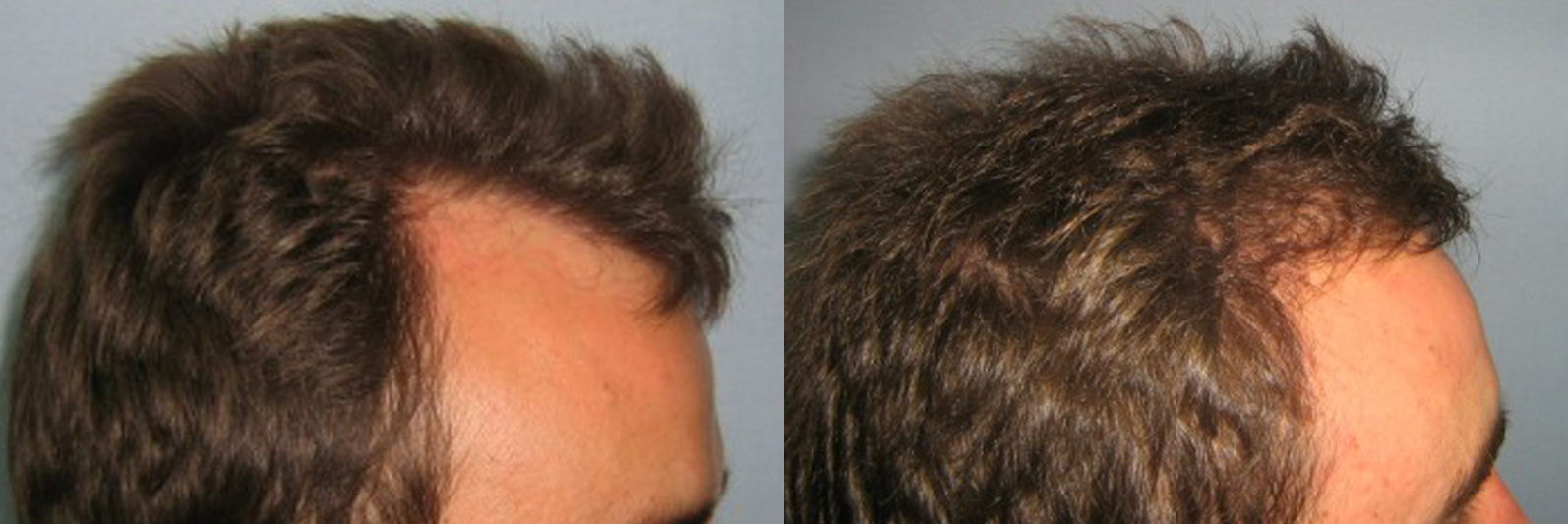 DHI Direct Hair Implantation